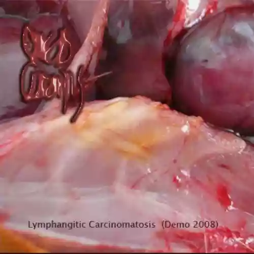 Cover di Lymphangitic Carcinomatosis (Demo 2008)
